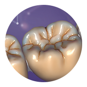 Coronas o puentes cementados